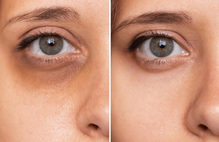 Intradermoterapia para ojeras pigmentadas - Profesionista de la salud